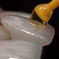 Ein Verneer wird auf einen Zahn aufgeklebt.