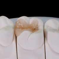 Kleine Restaurationen an einem Backenzahn mit Keramik-Inlay auf einem Zahnmodell.