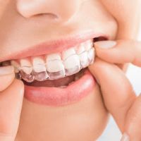 Eine durchsichtige Schiene wird &uuml;ber die Z&auml;hne gesteckt.