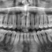 R&ouml;ntgenaufnahme eines Gebisses.