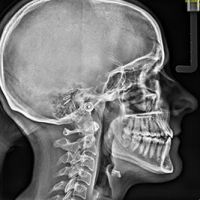 Seitliche R&ouml;ntgenaufnahme des Kopfes einer Patientin.